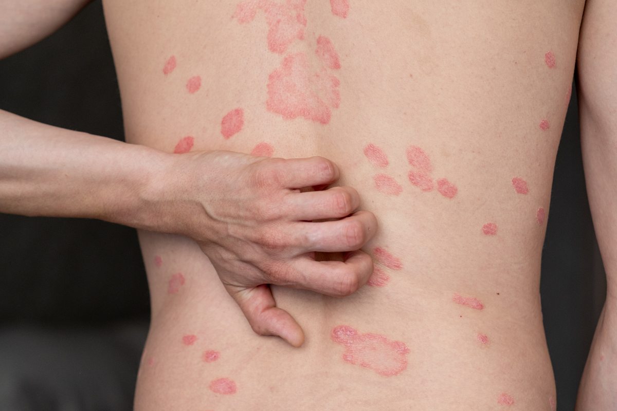 an ayurvedic approach to managing psoriasis 2